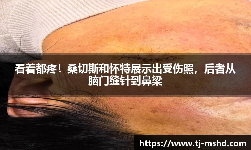 看着都疼！桑切斯和怀特展示出受伤照，后者从脑门缝针到鼻梁